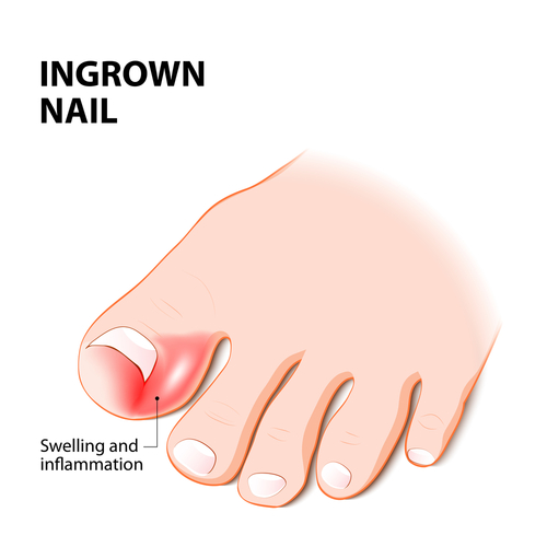 Ingrown Toenails | Campbelltown Podiatry